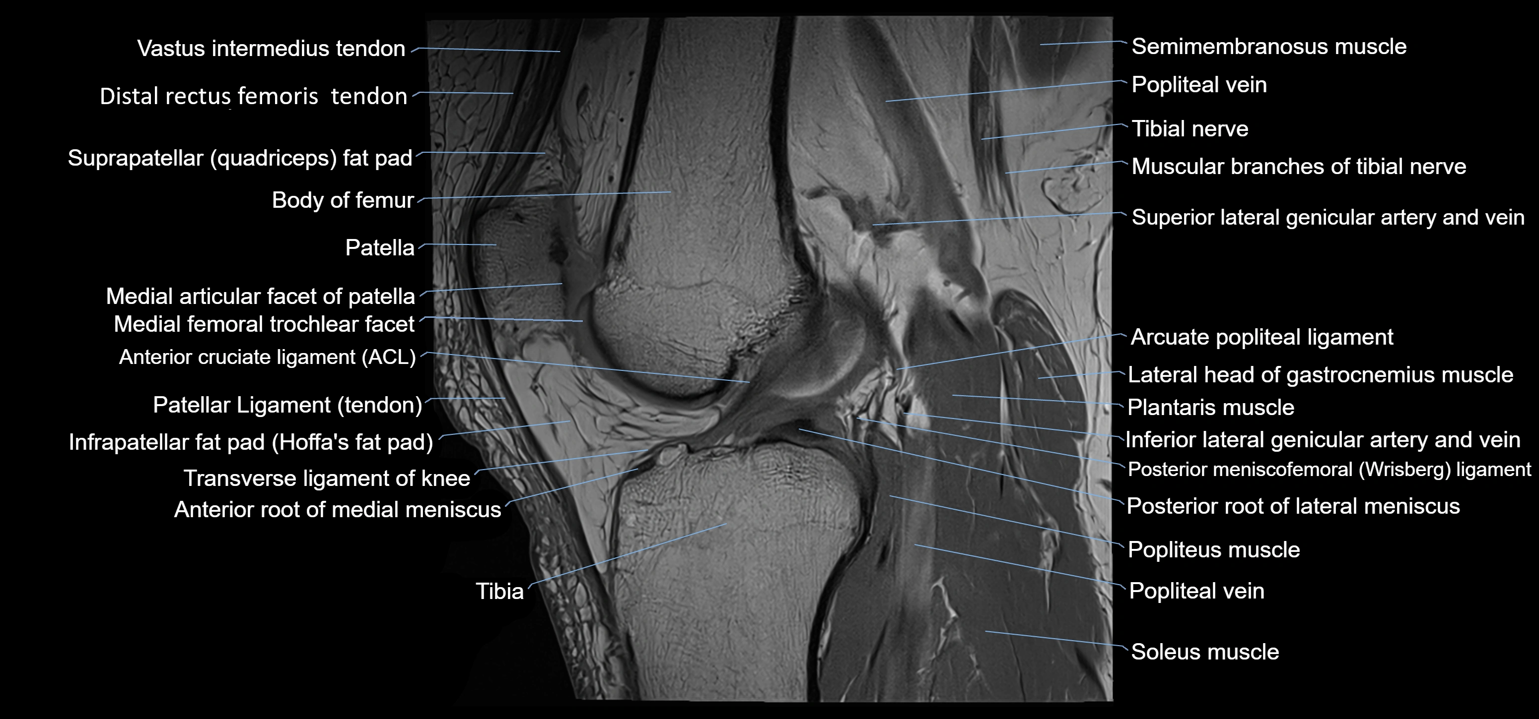MRI knee sagittal cross sectional anatomy labelled 3T radiology image-00027.webp